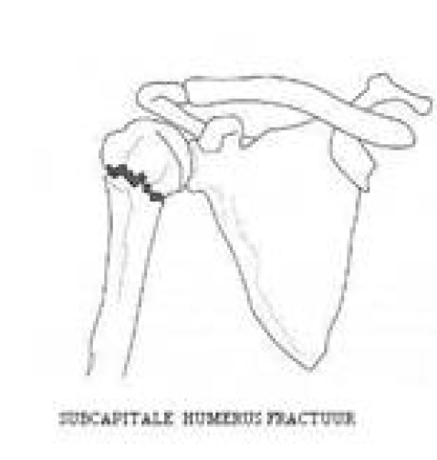 Subcapitale humerusfractuur