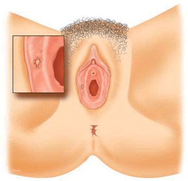 Pics vulva Category:Unshaved genitalia