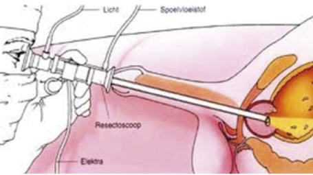 Prostaatbehandeling 2