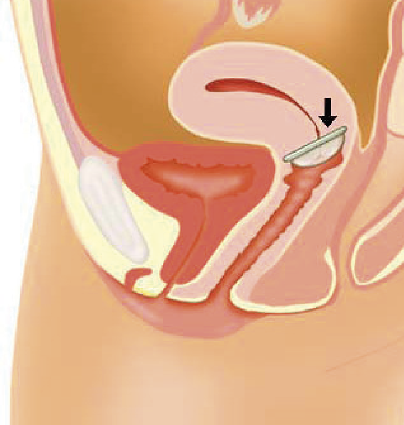 Anticonceptie Tergooi
