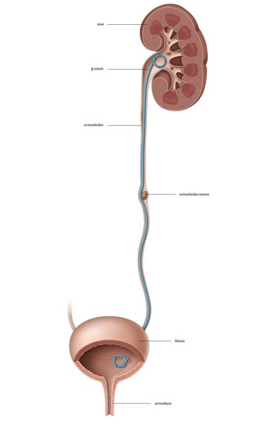 JJ stent Tergooi MC jj-stent-tergooi-mc