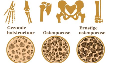 Osteoporosis