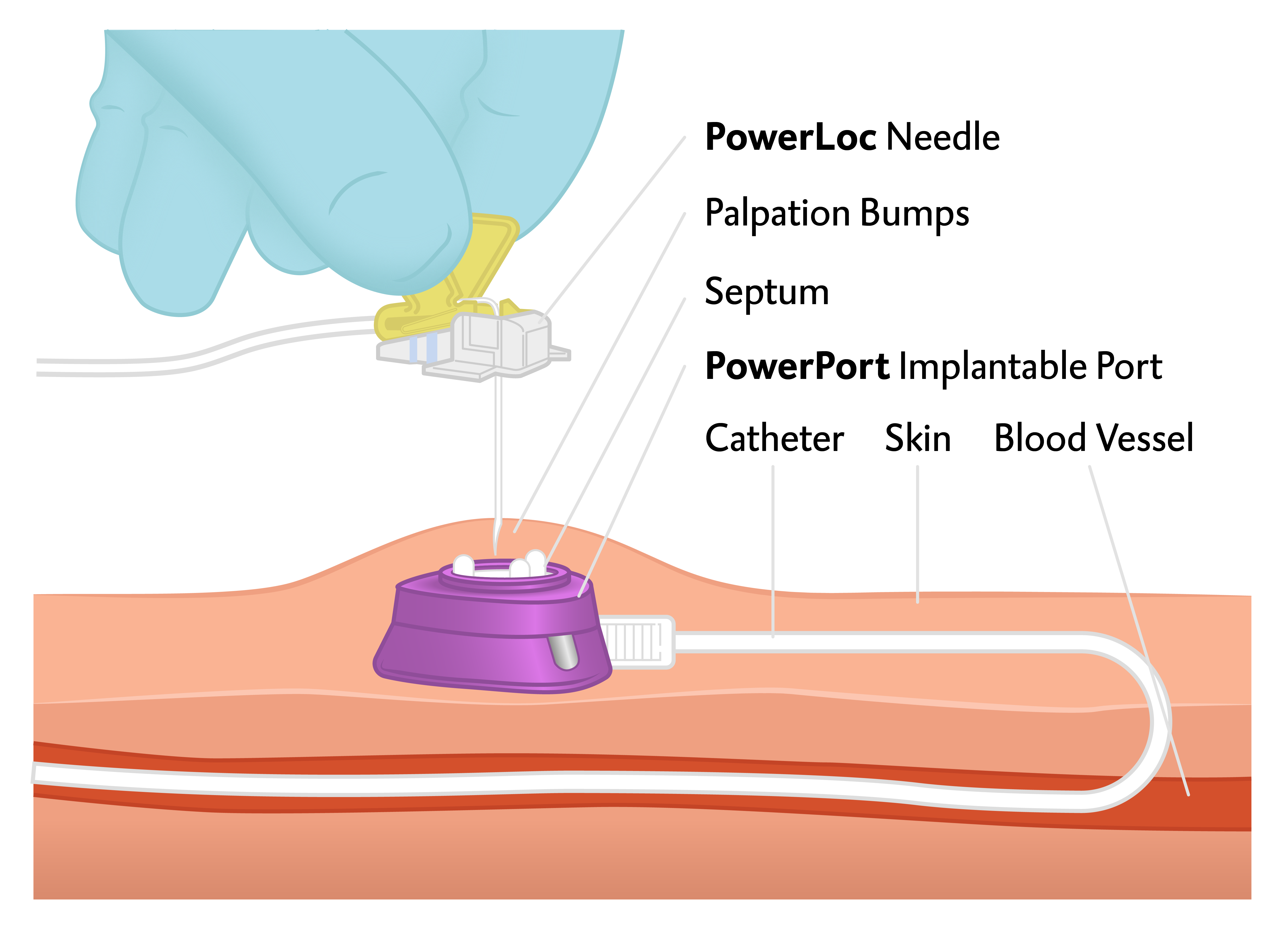 Port A Cath Definition Portkatheter SCTLP Port A Cath Definition Portkatheter SCTLP