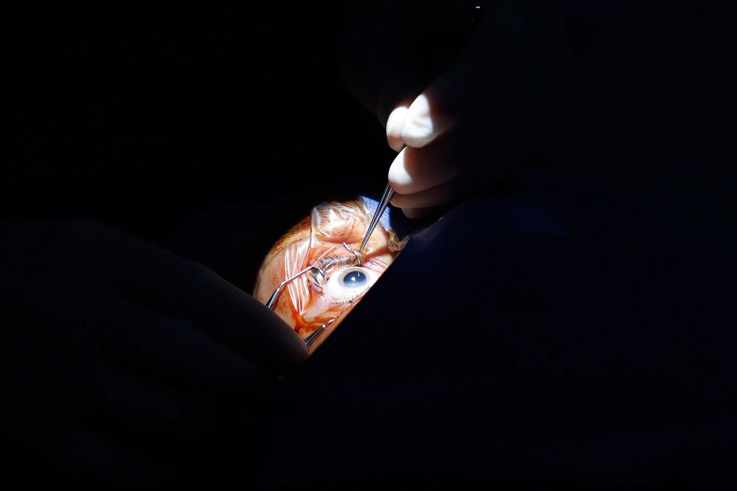 In het oog worden drie minuscule sneetjes gemaakt waar de oogarts door opereert Meekijken met een staaroperatie